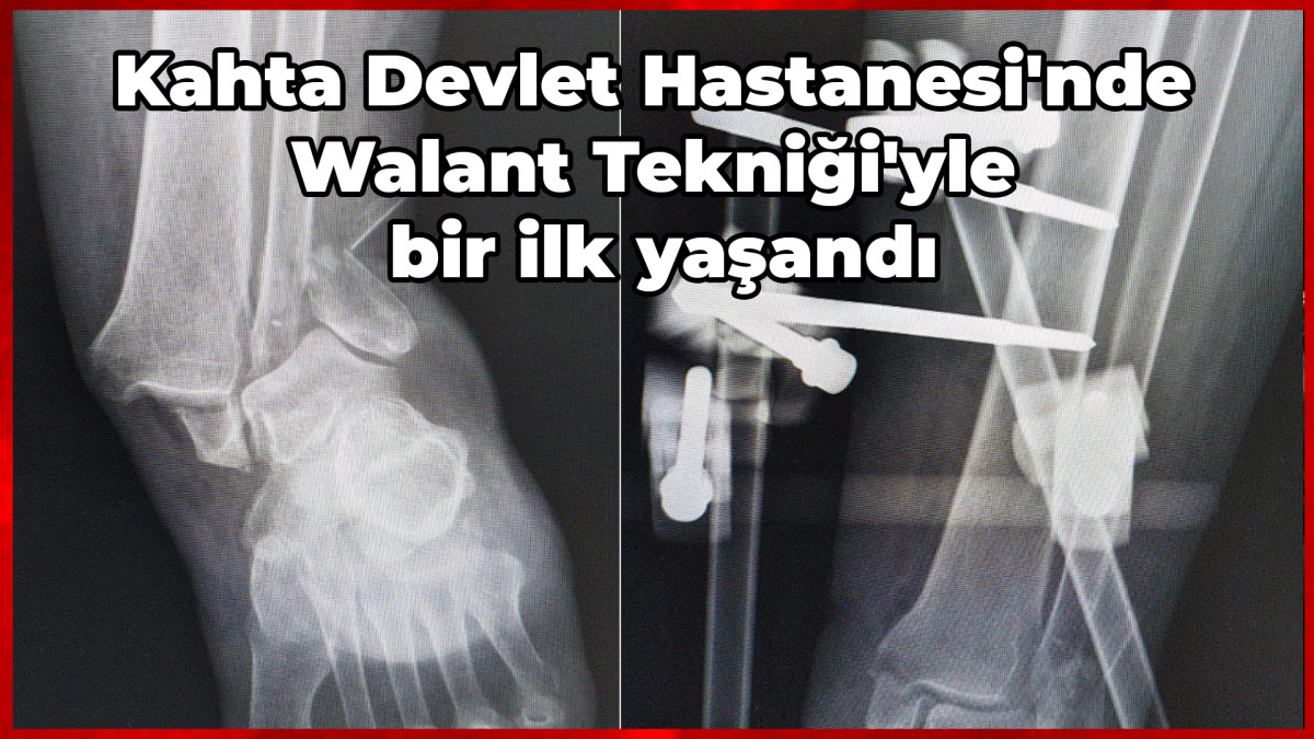 Kahta Devlet Hastanesi'nde Walant Tekniği'yle bir ilk yaşandı