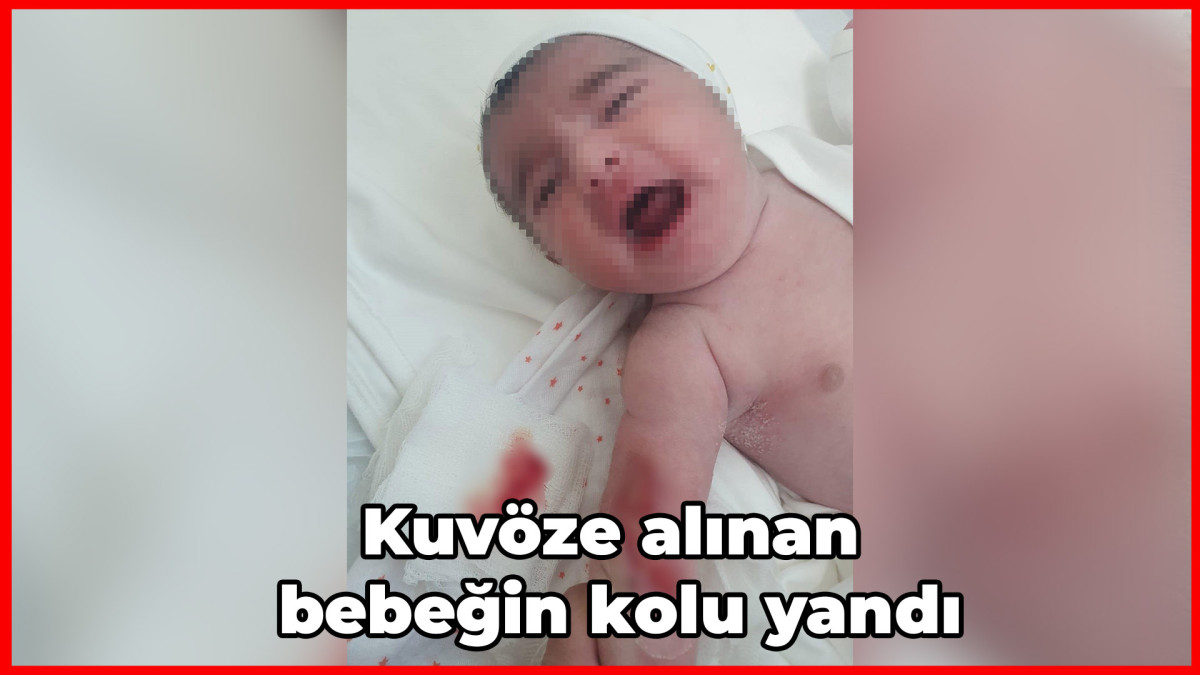 Kuvöze alınan bebeğin kolu yandı